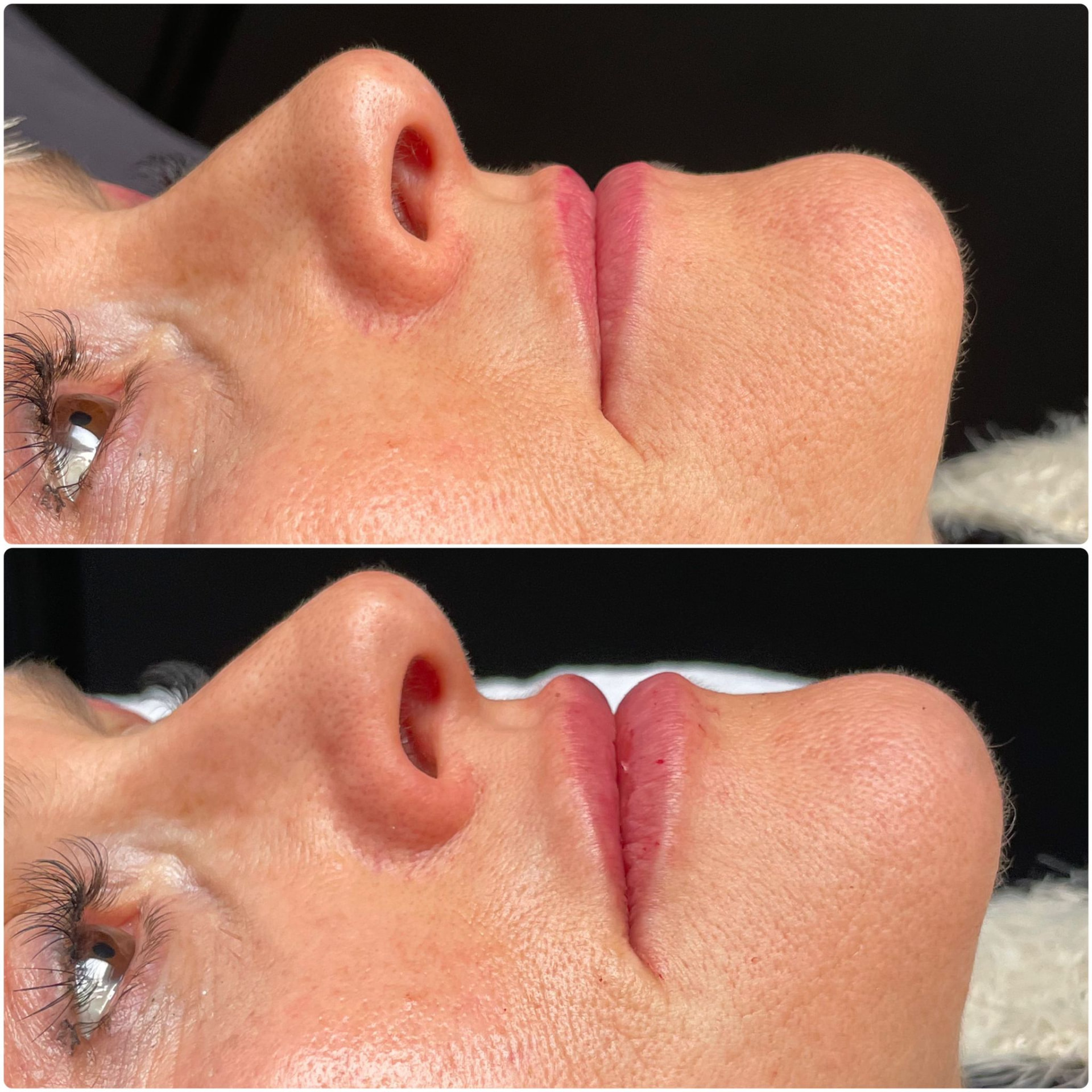 Vorher-Nachher-Ergebnis eines IRI® Filler
