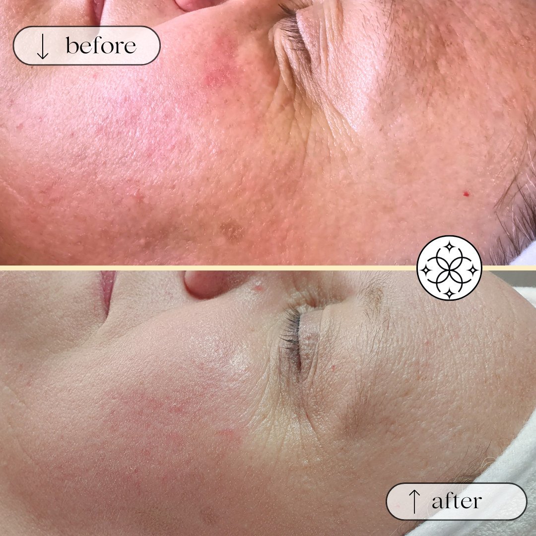 Vorher-Nachher-Ergebnis einer Medical Beauty Behandlung bei Couperose & Rosacea