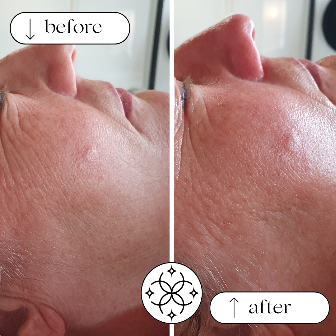 Vorher-Nachher-Ergebnis eines SkinPen Microneedling
